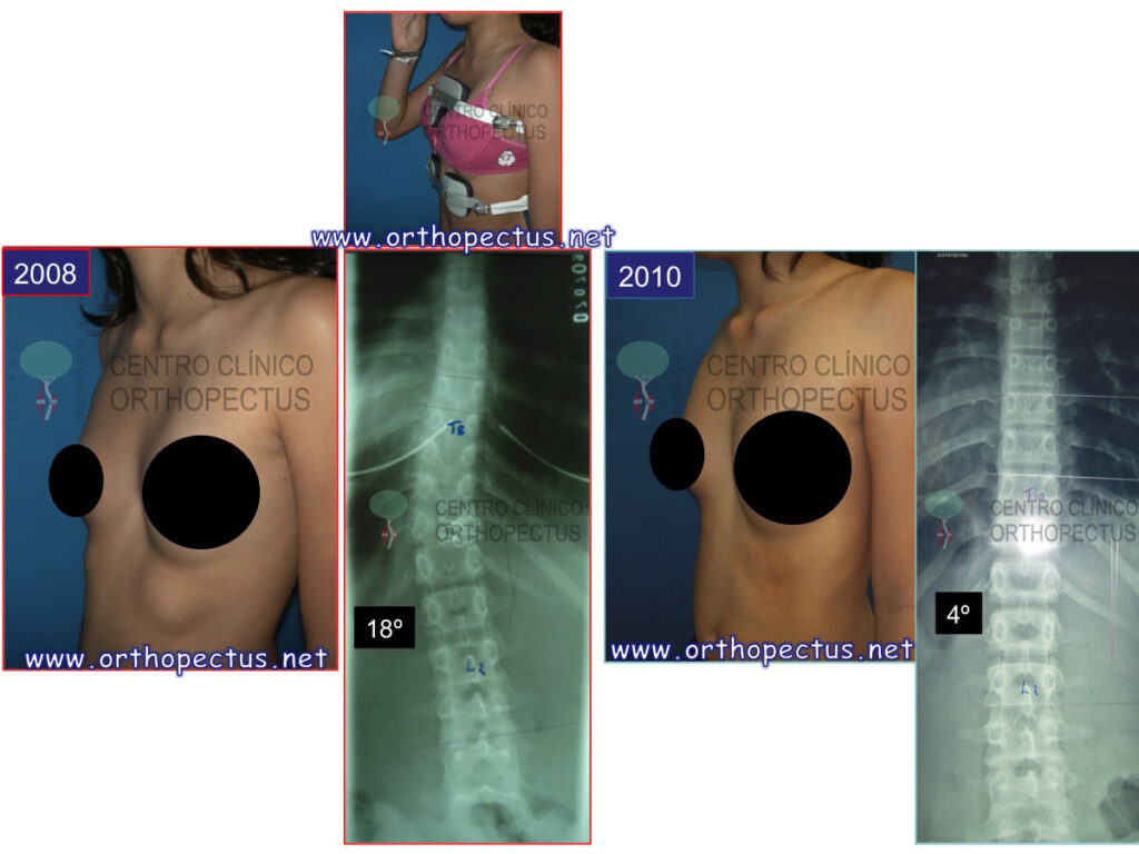 Tratamiento escoliosis: corsés (II)