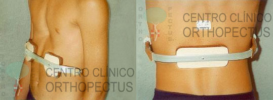 Tratamento Pectus Excavatum