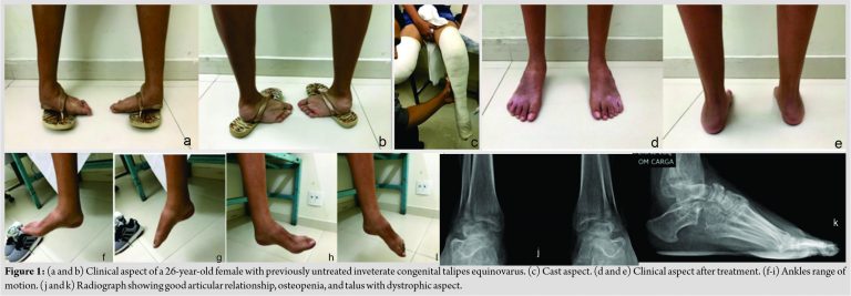 Tratamento de pé torto em adulto é destaque no Journal of Orthopedic Case Reports