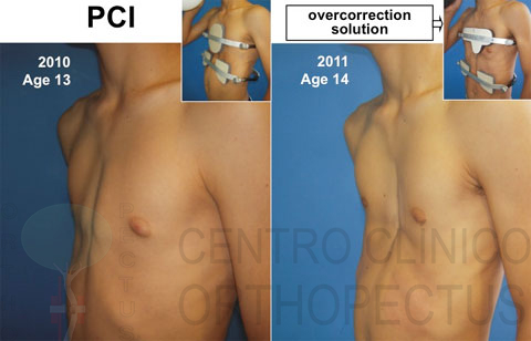 example of evolution clinical center orthopectus1