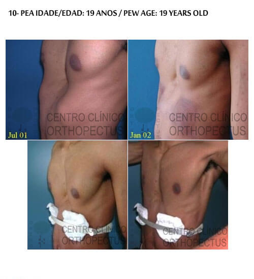 Pectus Excavatum Centro Clínico Orthopectus 11 pectus excavatum adolescente