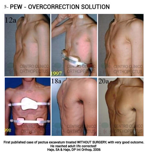 Pectus Excavatum Centro Clínico Orthopectus 6 pectus excavatum center orthopectus