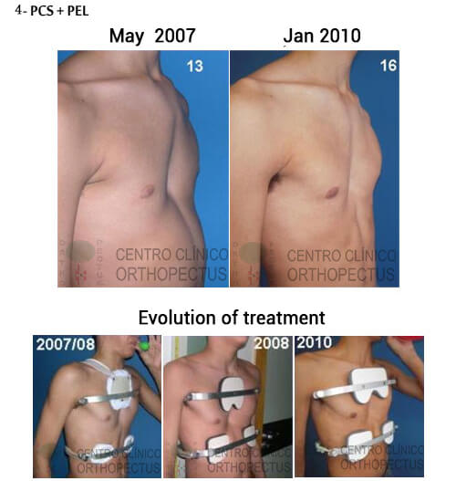 Pectus Excavatum Centro Clínico Orthopectus 5 pectus excavatum clinical center 1