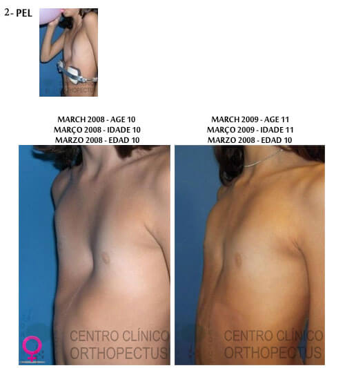 Pectus Excavatum Centro Clínico Orthopectus 3 pectus-excavatum-clinical-center-orthopectus-brasilia