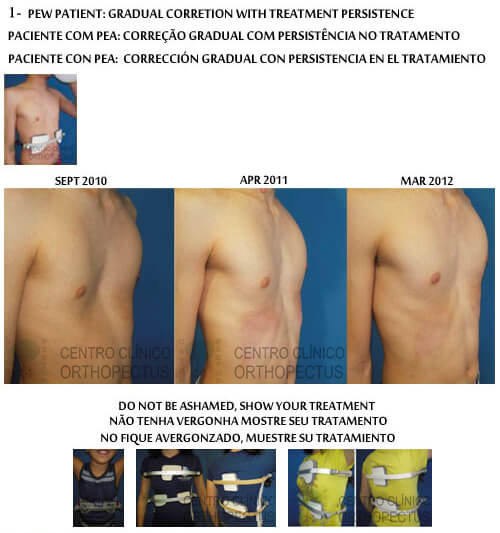 Pectus Excavatum Centro Clínico Orthopectus 2 pectus excavatum clinical center orthopectus