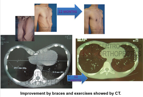 Pectus Excavatum Centro Clínico Orthopectus 13 pectus-excavatum-evolução-tratamento