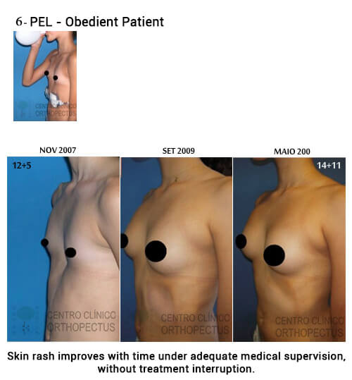 Pectus Excavatum Centro Clínico Orthopectus 7 pectus-excavatum-mulher