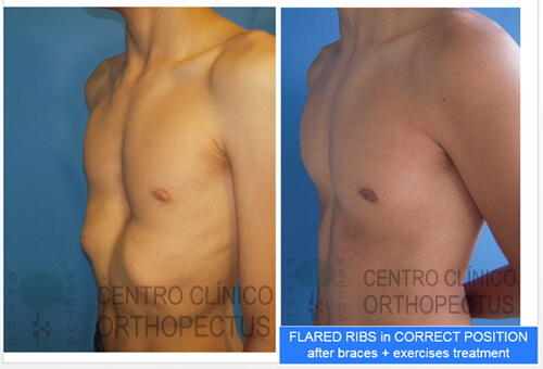 Pectus Excavatum Centro Clínico Orthopectus 12 pectus excavatum postura