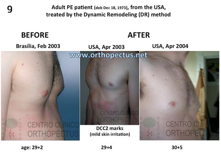 Pectus Excavatum Centro Clínico Orthopectus 10 pectus-excavatum-tratamento-colete