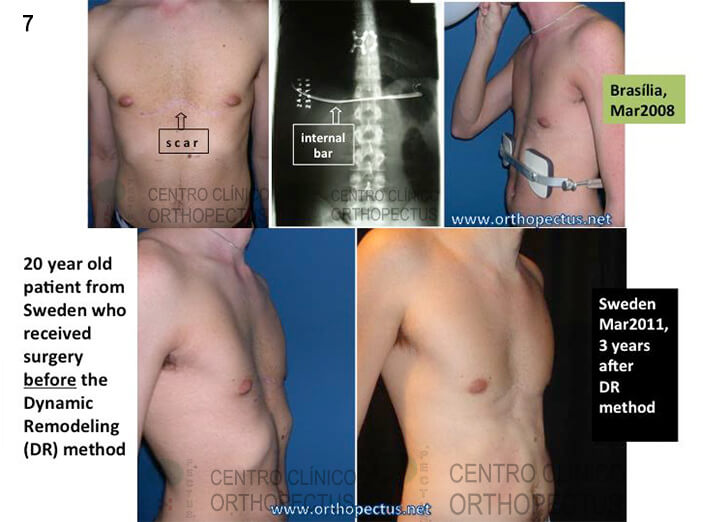 Pectus Excavatum Centro Clínico Orthopectus 8 pectus-excavatum-tratamento