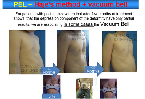 Pectus Excavatum Centro Clínico Orthopectus 14 pectus-excavatum-vacuum-bell