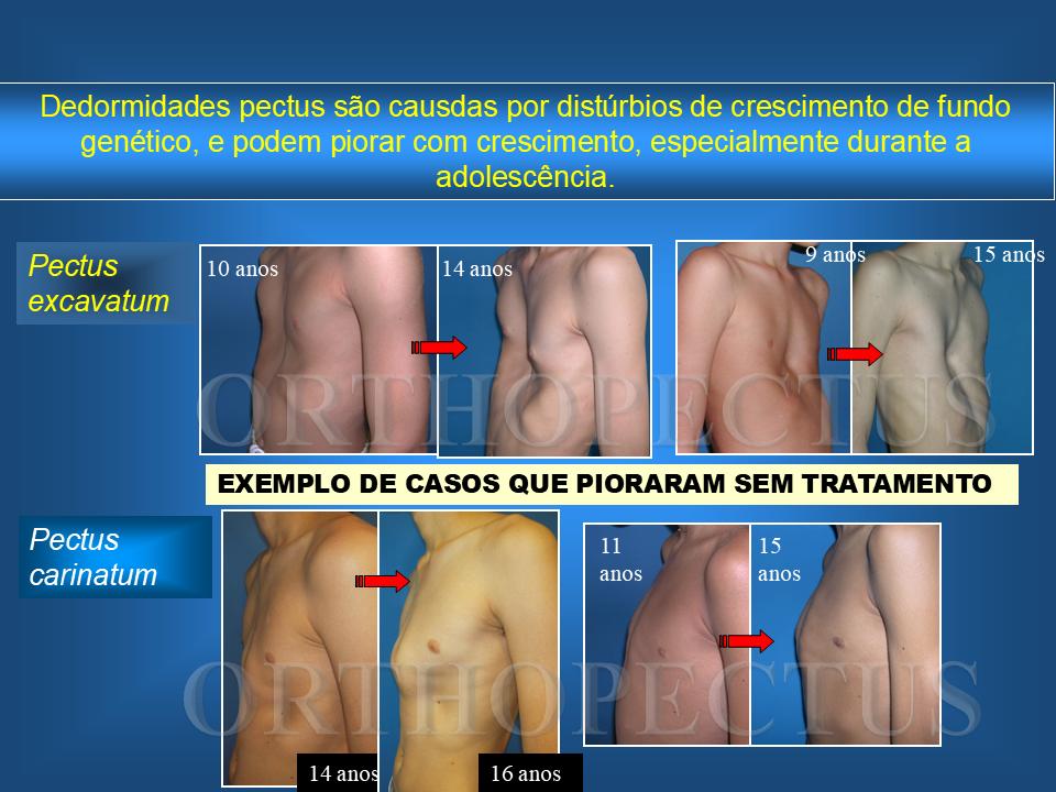 Os Riscos de Ignorar o Pectus Não Tratado 1 pectus não tratado