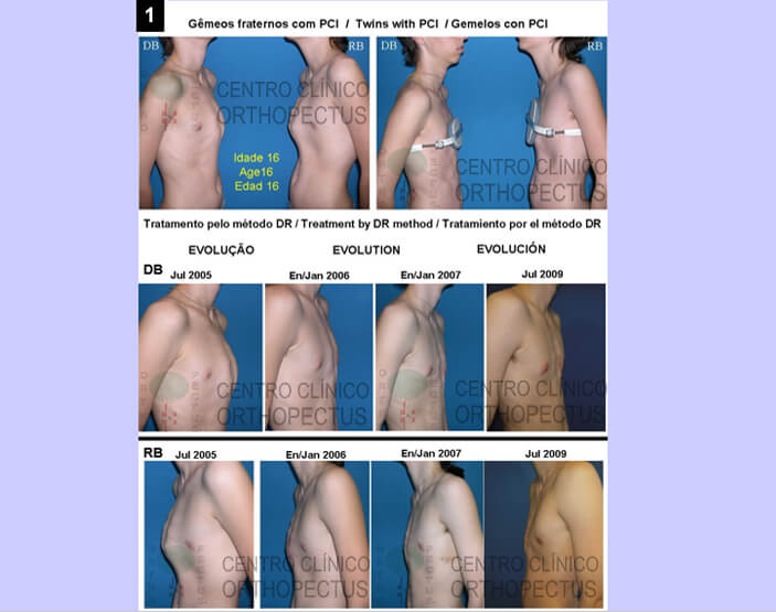 pectus carinatum tratamento 1