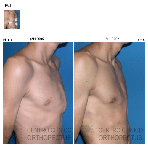 pectus-carinatum-tratamento -a antes e depois resultados
