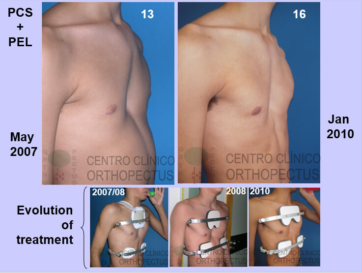 pectus-carinatum-tratamento