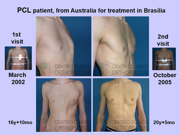 pectus-carinatum-tratamento - resultados antes e depois