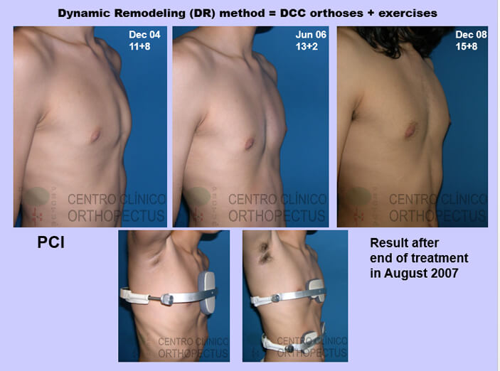 pectus-carinatum-tratamento