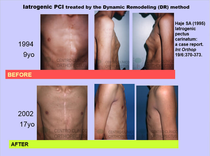 pectus-carinatum-tratamento