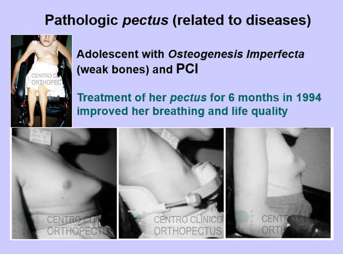 pectus-carinatum-tratamento