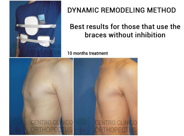 pectus-carinatum-tratamento - fotos