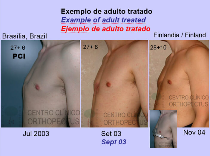 pectus-carinatum-tratamento - antes e depois