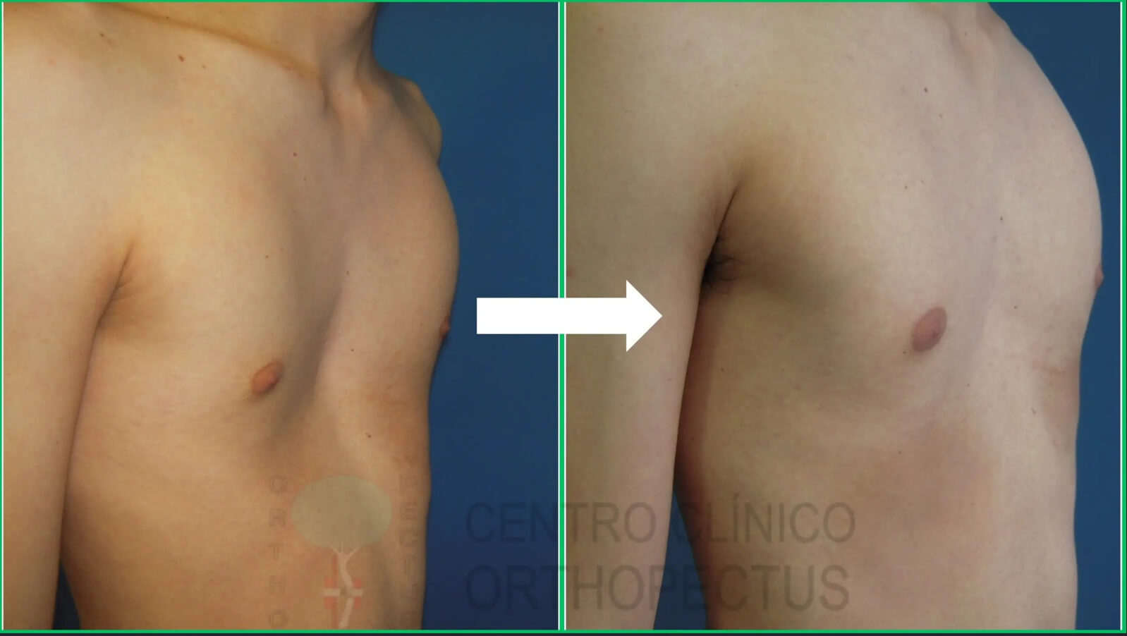 Pectus Excavatum SEVERO também pode ser tratado sem cirurgia