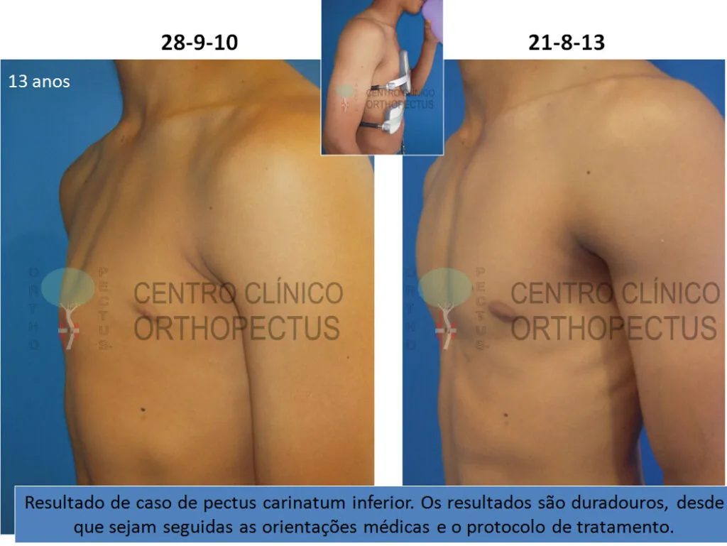 Pectus Carinatum Inferior