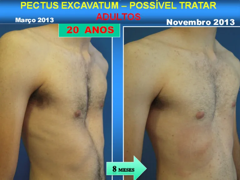 Tratamento Pectus Excavatum