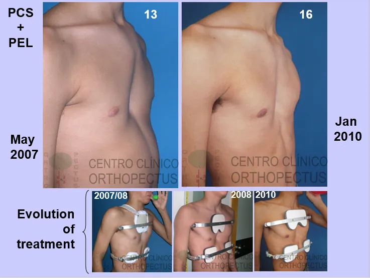 pectus carinatum treated cases3