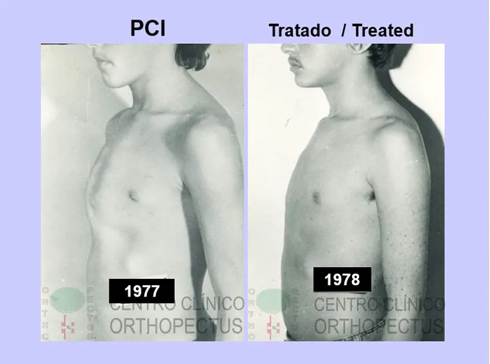 pectus carinatum treated cases71