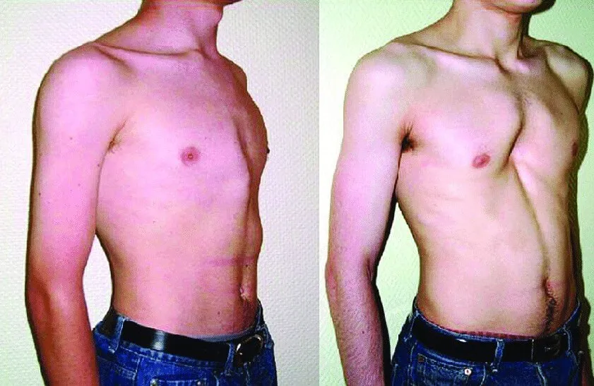 diferenças entre pectus excavatum e carinatum