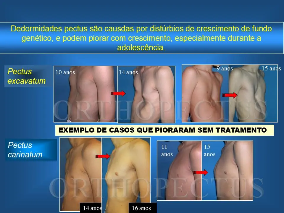Os Riscos de Ignorar o Pectus Não Tratado 1 pectus não tratado